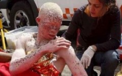 Nella foto, Moszy: l'africano albino che nel 2007 chiese asilo politico in Spagna perché perseguitato dagli stregoni della sua nazione